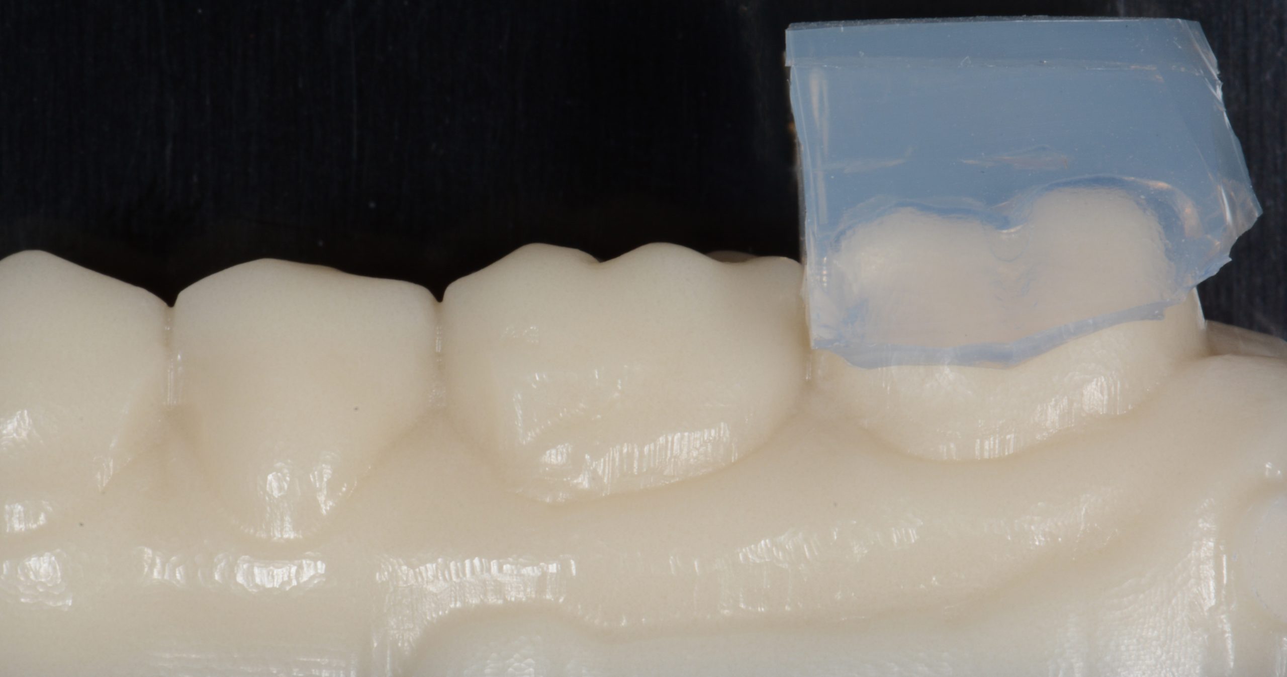 Direct and Indirect Adhesive Restorations – Minimal Invasive Treatment of the Anterior and Posterior Damaged Dentition using Direct Bonded Restorations (Updated with New Content)