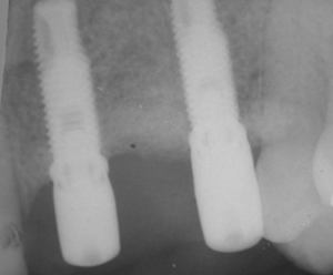 CLINICAL VIDEO Vertical Augmentation, membrane removal and implant placement