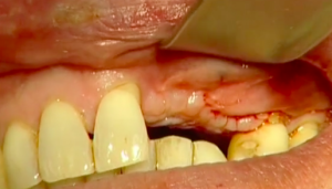 CLINICAL VIDEO Modified Free Connective Tissue Graft