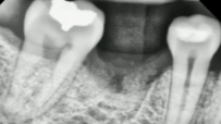 CLINICAL VIDEO Socket Preservation after a Lower Molar Extraction using an Allograft and a d-PTFE Membrane