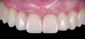 CLINICAL VIDEO Biological Potential of Hard and Soft Tissues - From Bone Resorption to Planned Implant Therapy to Predictable Gingival Esthetics