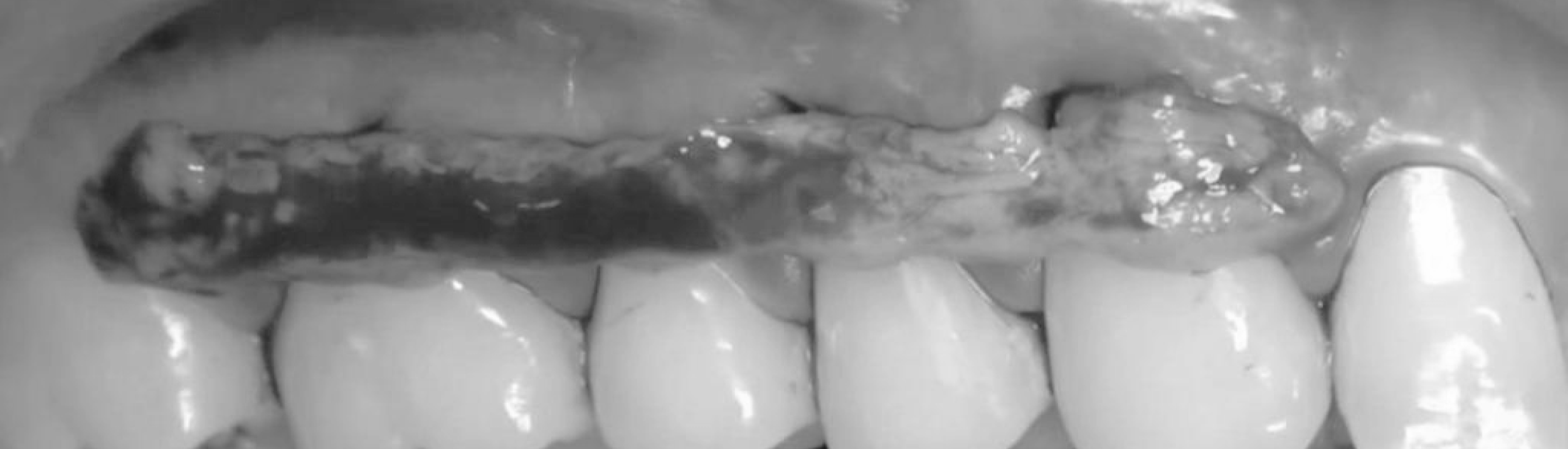 Tunneling & Mucogingival Therapy for Soft Tissue Management & Esthetics in 6 Videos | Carranza, Kahn, Jovanovic, Mintrone