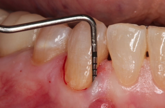 Delayed extraction site Treatment with a TLX Implant & simultaneous GBR procedure