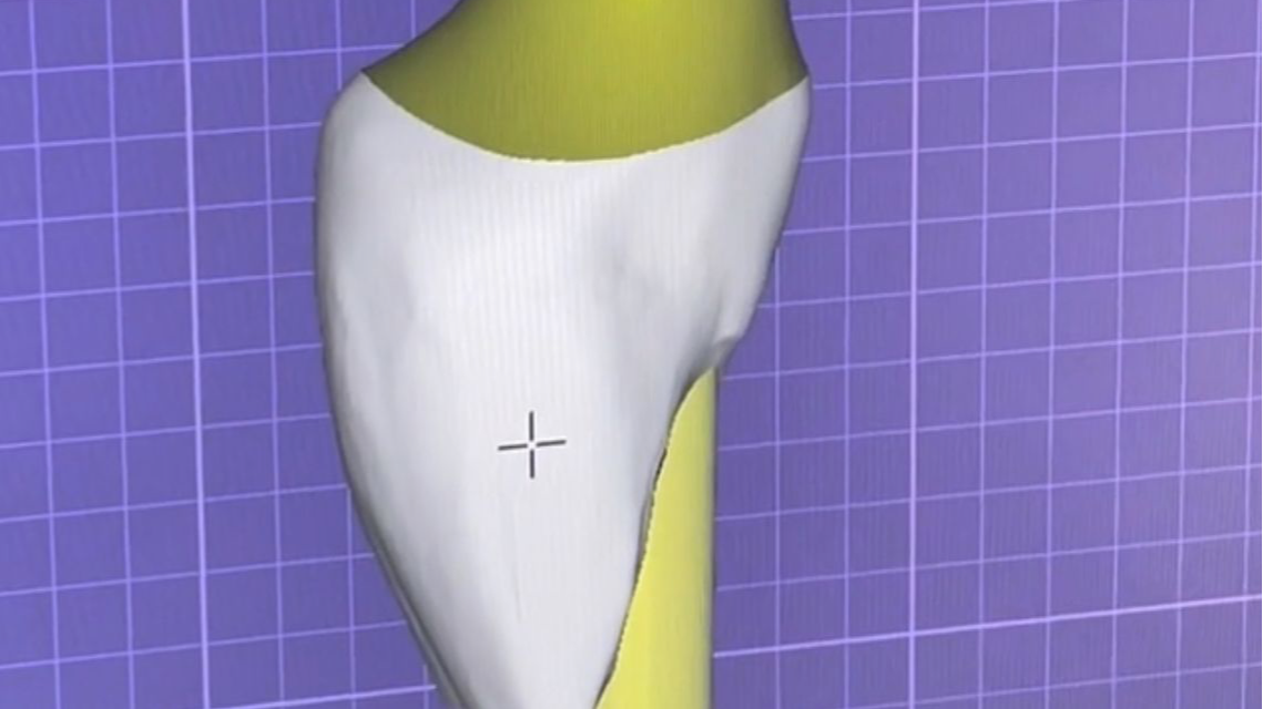 Immediate 3D Designed and Printed Implant Temporization at Uncovering of an Anterior Re-Treated Implant Site