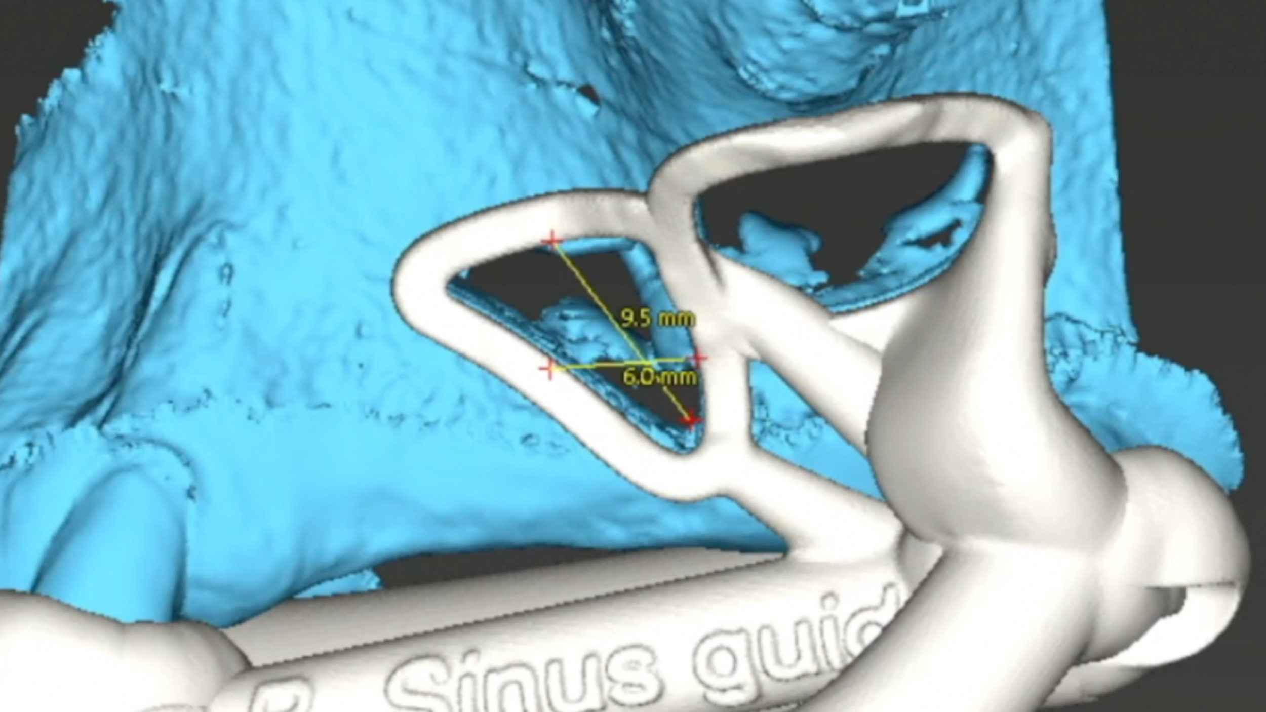 A Step-by-Step Digital Workflow to Design a 3D Printed Sinus Window and Septum Surgical Guide